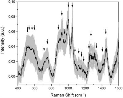 Identification of the Raman Salivary Fingerprint of Parkinson’s Disease Through the Spectroscopic– Computational Combinatory Approach